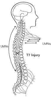 FIGURE 1.7. Upper Motor Neuron Injury