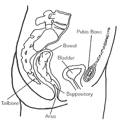 FIGURE 7.2. Suppository Placement